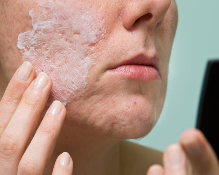 Benzoyl Peroxide for Acne Treatment